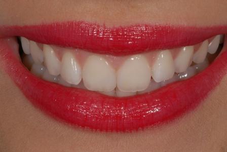 Beautiful teeth are a reason to smile! Perfect dental aesthetics with Amaris (cl