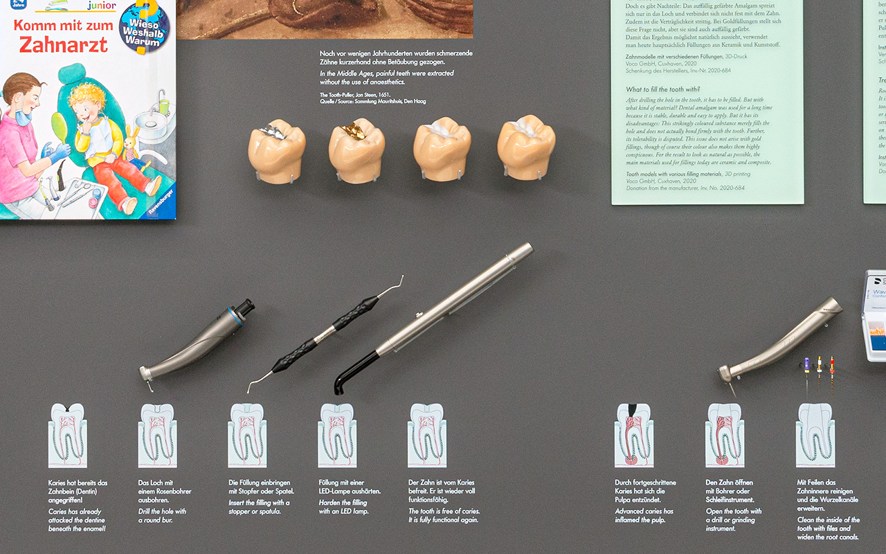 Die vier 3D-gedruckten Zahnmodelle zeigen die unterschiedlichen Füllungsmaterial