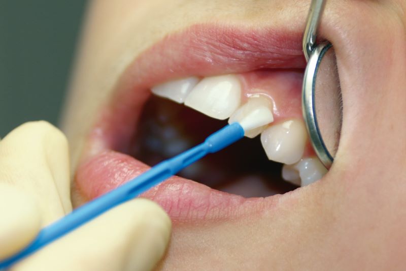VOCO Profluorid Varnish eignet sich ideal zur Behandlung von hypersensiblen Zähn
