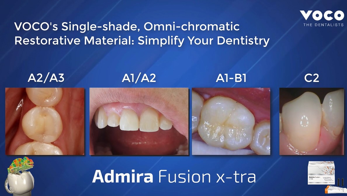 Admira Fusion x-tra clinical examples across multiple shades